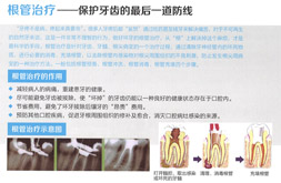 根管治疗